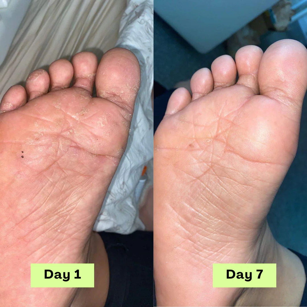 Antifungal Tea Tree Therapy Bar