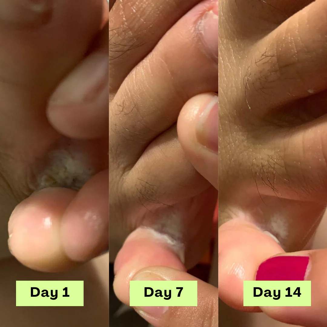 Antifungal Tea Tree Therapy Bar